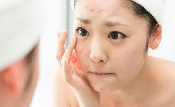 Cách chăm sóc da mụn hiệu quả
