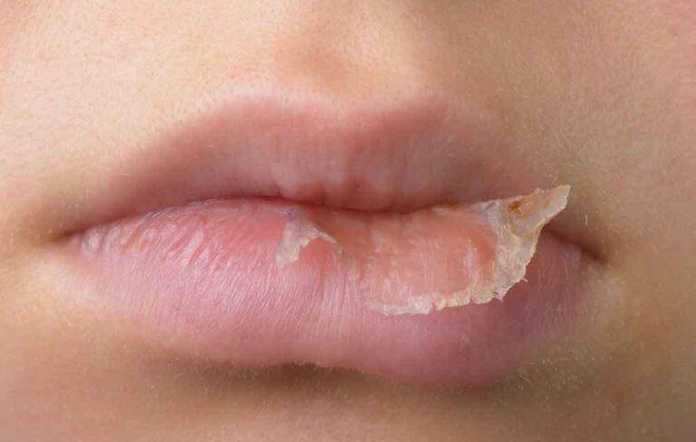 Môi nứt nẻ do ánh nắng mặt trời