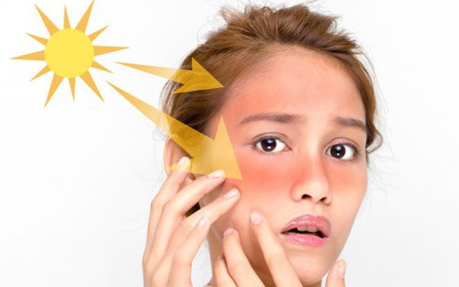 Khuyến nghị không trang điểm khi da cháy nắng